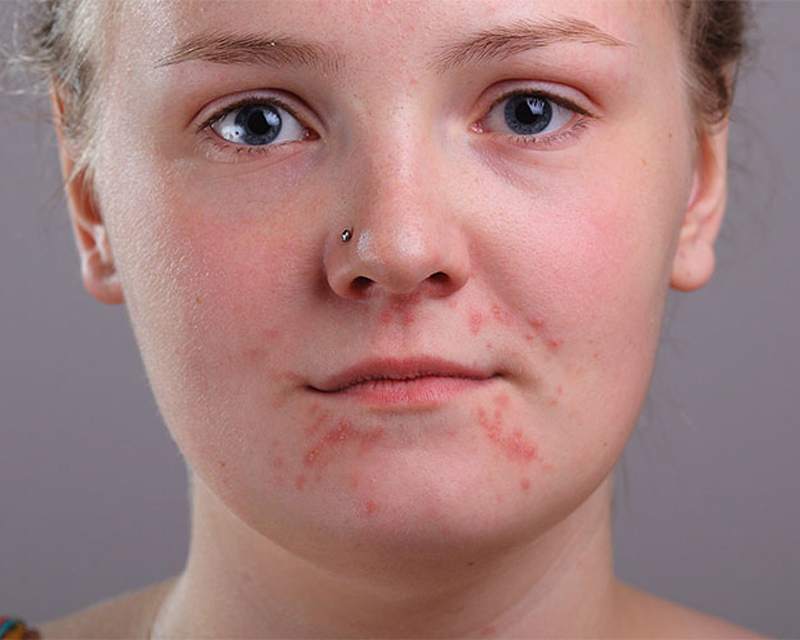 The same close portrait with breakouts and redness around the mouth and chin.